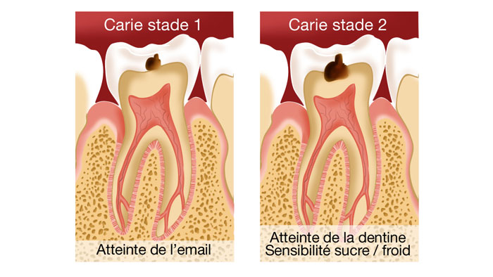 Traitement carie stade 1 et 2