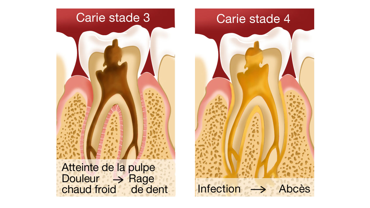 Traitement carie stade 3 et 4