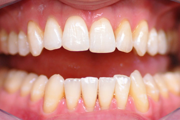 Blanchiment dentaire après