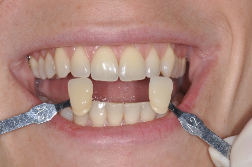 Éclaircissement gain de 3 teintes