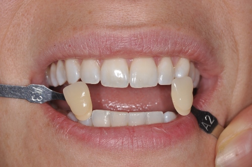 Résultat avant/après esthétique Paris 7 Blanchiment gain de 3 teintes