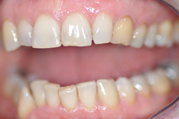 Eclaircissement interne de dent dévitalisée plus composite