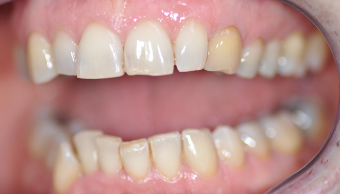 Eclaircissement interne de dent dévitalisée plus composite