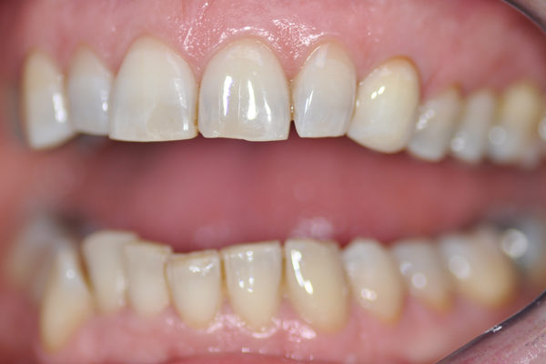 Blanchiment interne de dent dévitalisée plus composite