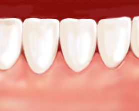 Greffe gingivale après la cicatrisation