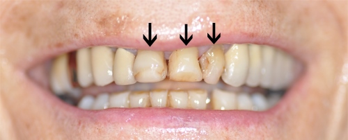 3 couronnes céramiques restaurées avant