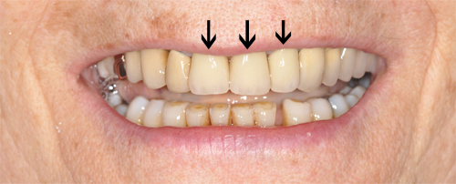 3 couronnes céramiques restaurées après