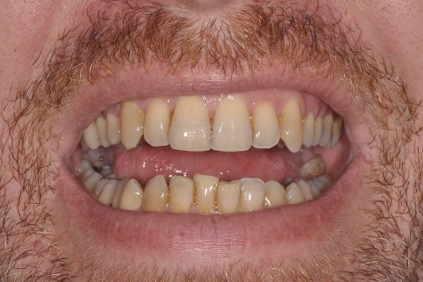 Blanchiment dentaire avant 1