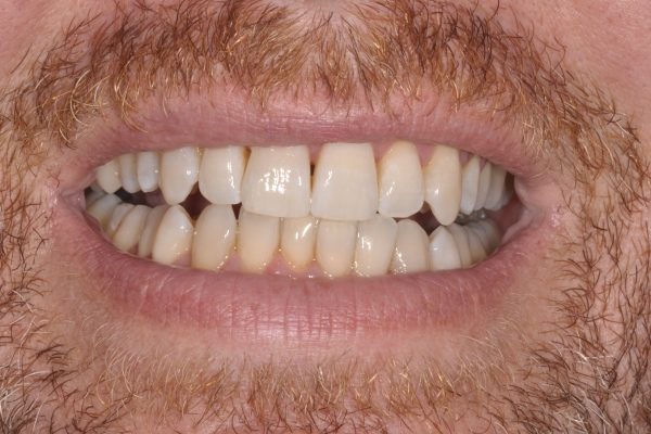 Blanchiment dentaire après une semaine