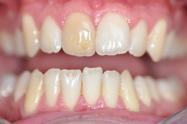 Une facette Feldspathic avec éclaircissement dentaire avant