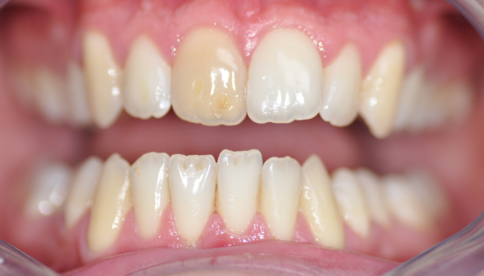 Une facette Feldspathic avec éclaircissement dentaire avant