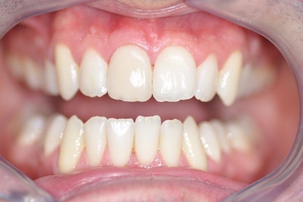 Une facette Feldspathic avec éclaircissement dentaire après