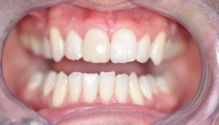 Une facette Feldspathic avec éclaircissement dentaire après