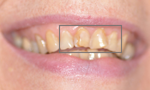 Facettes céramiques dentaires Feldspathic des 4 incisives avant