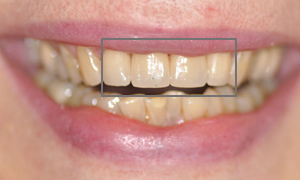 Facettes céramiques dentaires Feldspathic des 4 incisives après