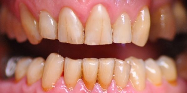 Facettes Pelliculaires avant