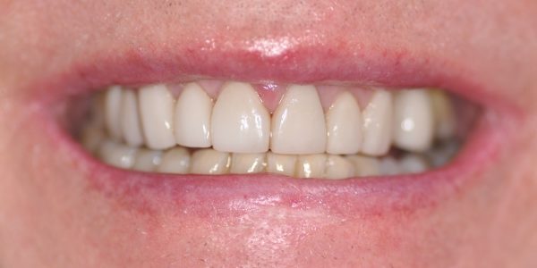 Facettes Pelliculaires apres