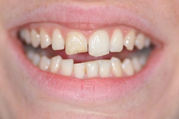 Restauration du sourire par composite dentaire debut