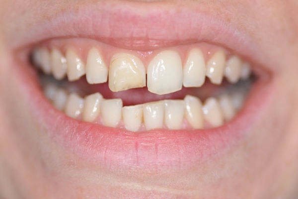 Restauration du sourire par composite dentaire debut
