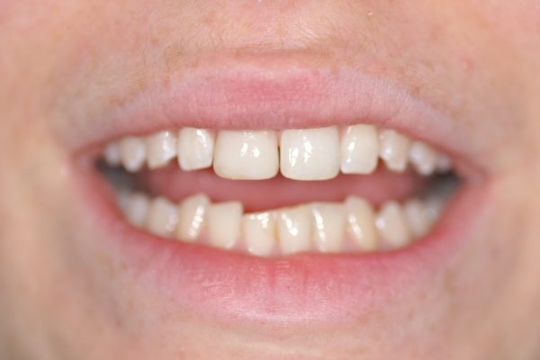 Restauration du sourire par composite dentaire milieu