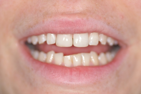 Restauration du sourire par composite dentaire milieu