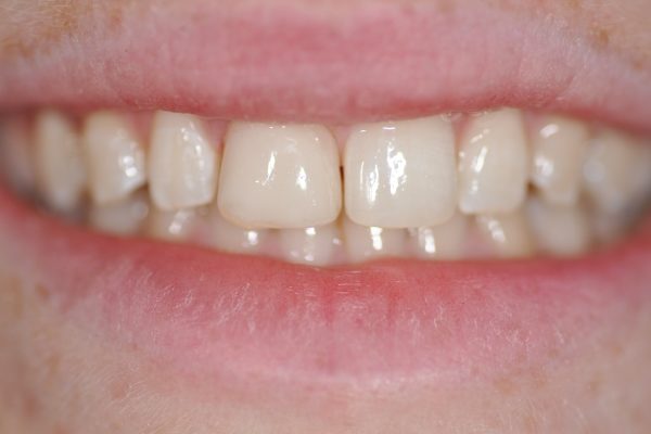 Restauration du sourire par composite dentaire fin